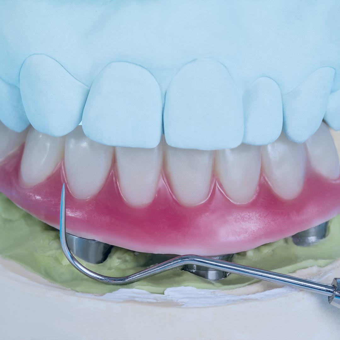 Clínica Dental Urresti prótesis dental