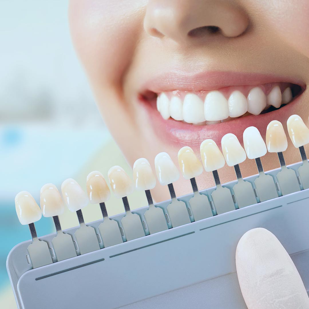 Clínica Dental Urresti blanqueamiento dental