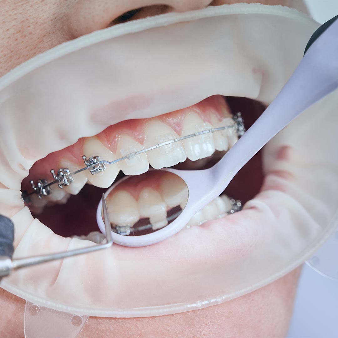 Clínica Dental Urresti aparato ortopédico removible