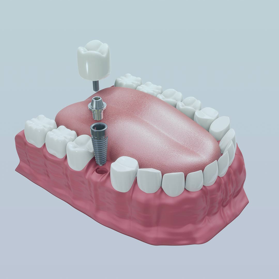 Clínica Dental Urresti por un diente perdido